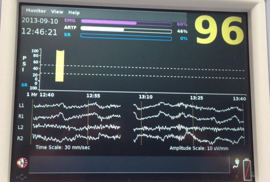 An operating room vital signs monitor shows EEG readings