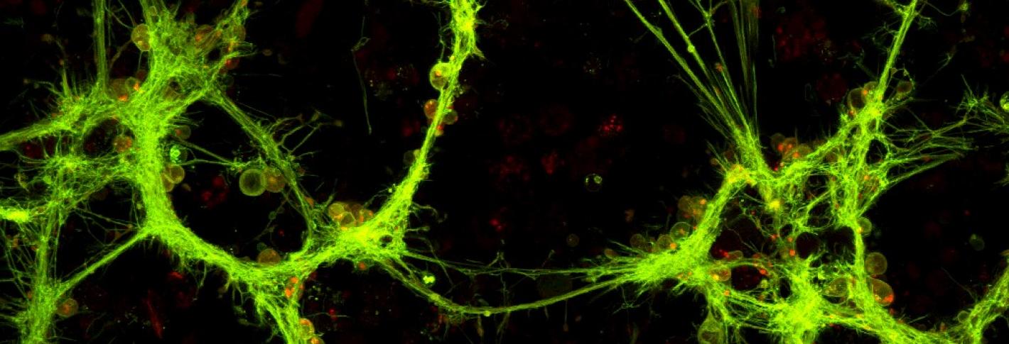 Bright yellow wisps indicate aggregated mutant huntingtin protein.