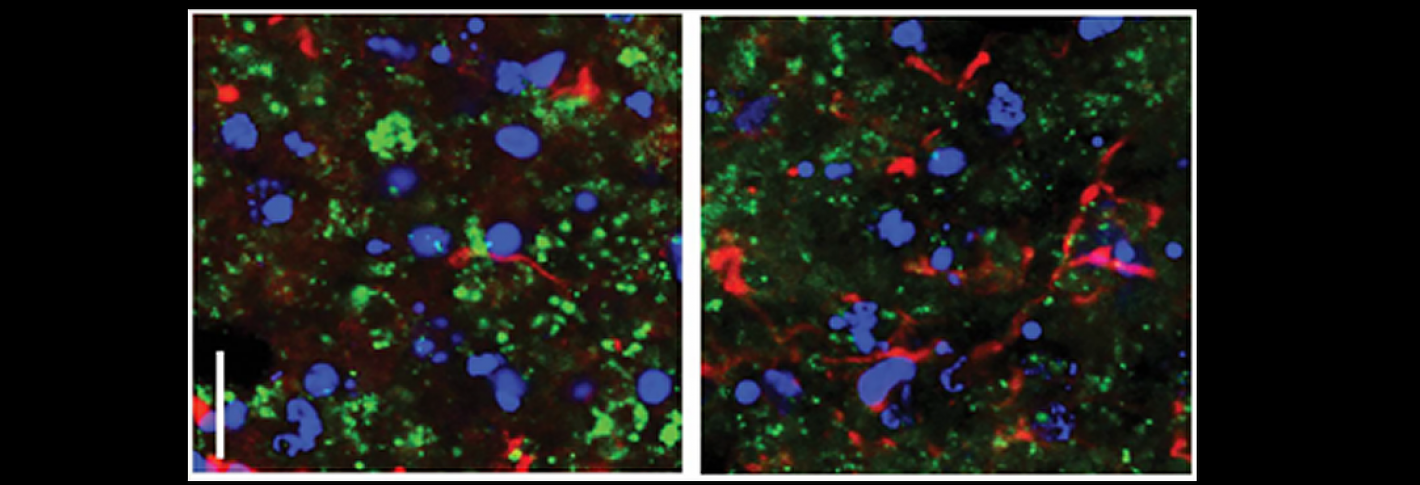 Amyloid beta enhanced in APOE4